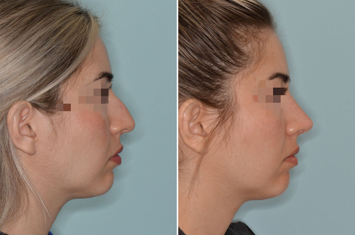 Rhinoplasty Photos 