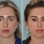 Rhinoplasty Before and After Photos in Miami, FL, Patient 7877