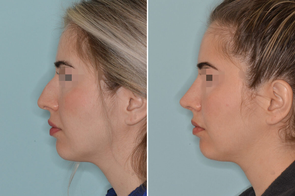 Rhinoplasty Before and After Photos in Miami, FL, Patient 7877