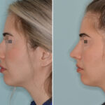 Rhinoplasty Before and After Photos in Miami, FL, Patient 7877