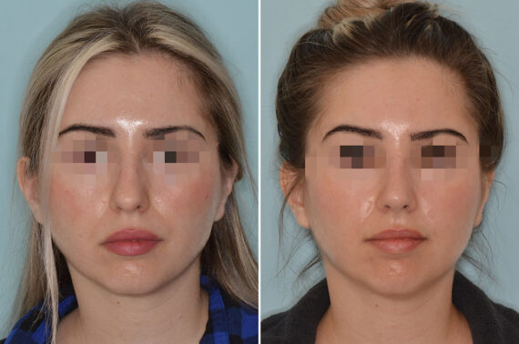 Rhinoplasty Before and After Photos in Miami, FL, Patient 7877