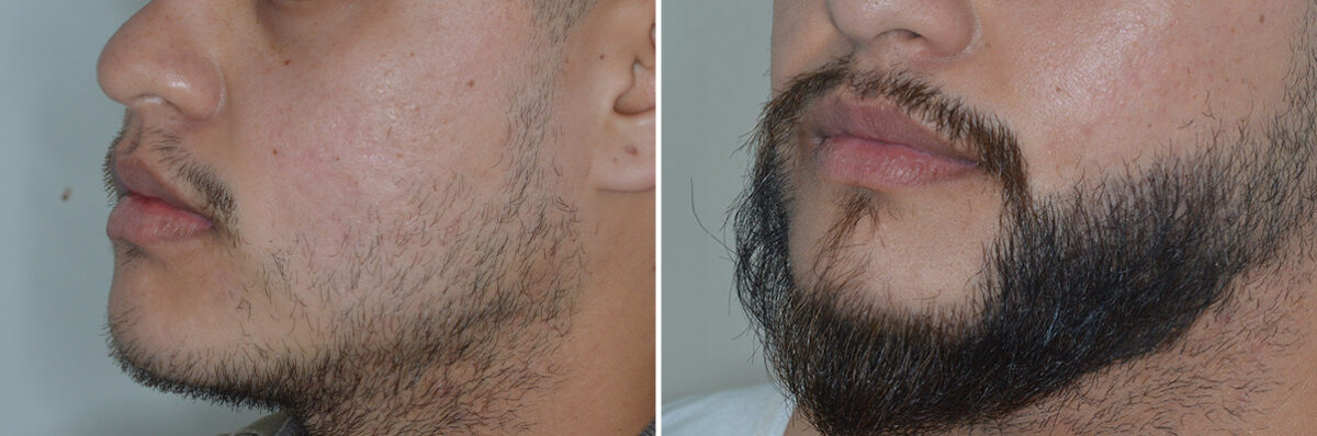 Beard Transplant Before and After Photos in Miami, FL, Patient 6723