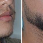 Beard Transplant Before and After Photos in Miami, FL, Patient 6723