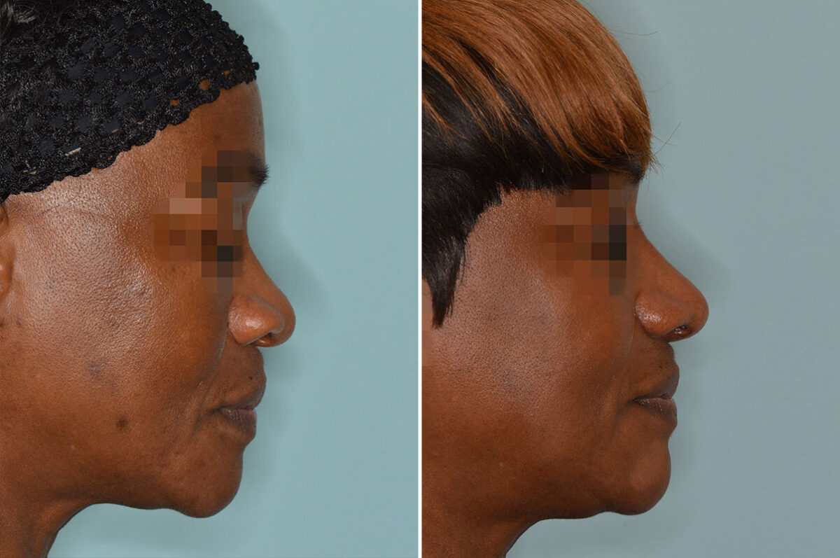 Ethnic Rhinoplasty Before and After Photos in Miami, FL, Patient 7911