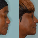 Ethnic Rhinoplasty Before and After Photos in Miami, FL, Patient 7911