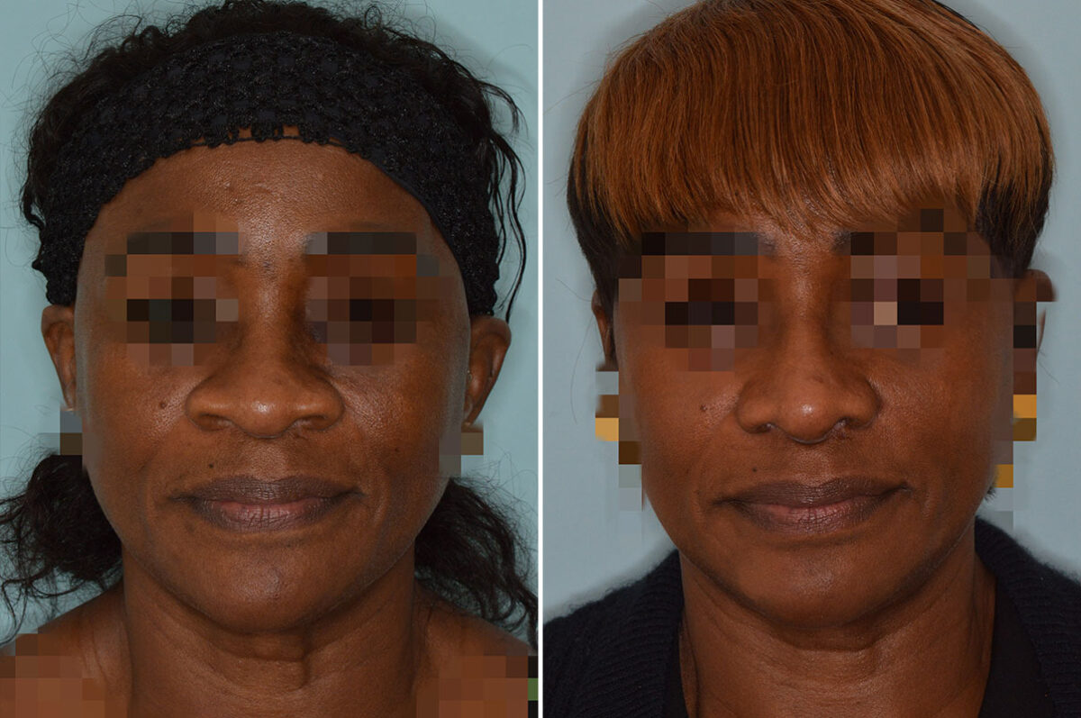 Ethnic Rhinoplasty Before and After Photos in Miami, FL, Patient 7911