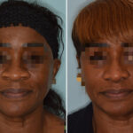 Ethnic Rhinoplasty Before and After Photos in Miami, FL, Patient 7911