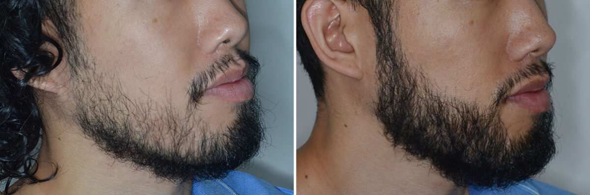 Beard Transplant Before and After Photos in Miami, FL, Patient 7921