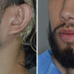 Beard Transplant Before and After Photos in Miami, FL, Patient 7921
