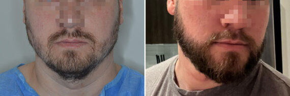 Beard Transplant Before and After Photos in Miami, FL, Patient 7931