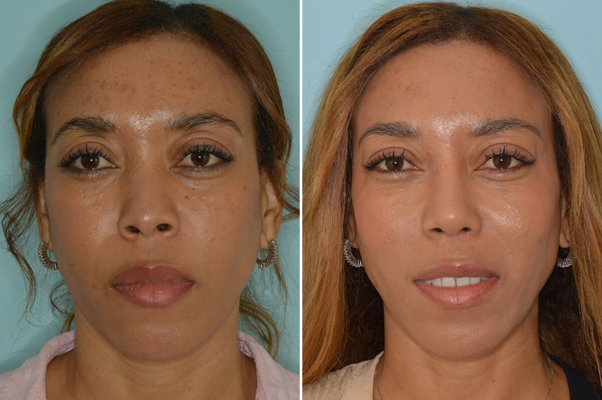 Ethnic Rhinoplasty Before and After Photos in Miami, FL, Patient 7939