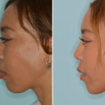 Ethnic Rhinoplasty Before and After Photos in Miami, FL, Patient 7939