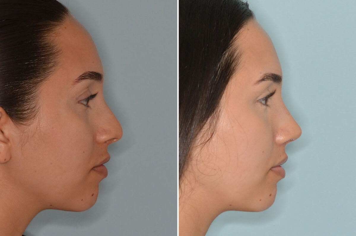 Rhinoplasty Before and After Photos in Miami, FL, Patient 7949