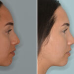 Rhinoplasty Before and After Photos in Miami, FL, Patient 7949