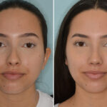 Rhinoplasty Before and After Photos in Miami, FL, Patient 7949