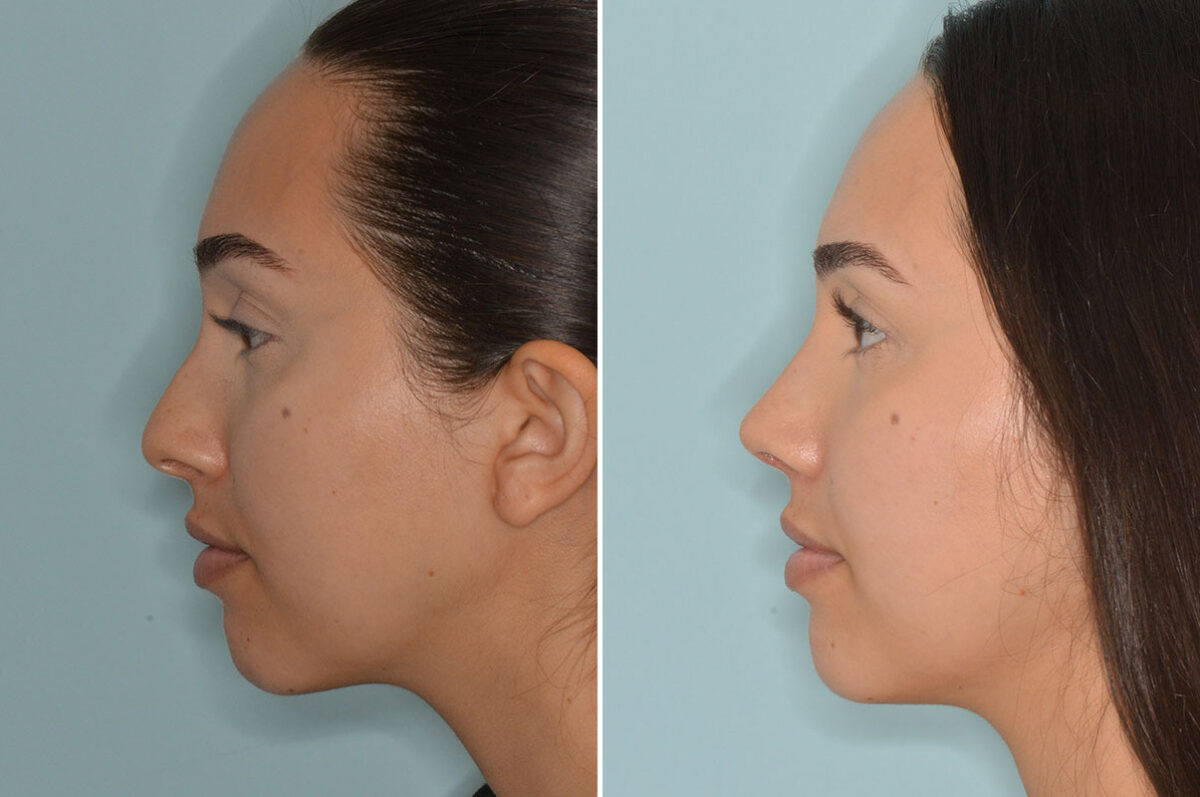 Rhinoplasty Before and After Photos in Miami, FL, Patient 7949