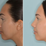 Rhinoplasty Before and After Photos in Miami, FL, Patient 7949