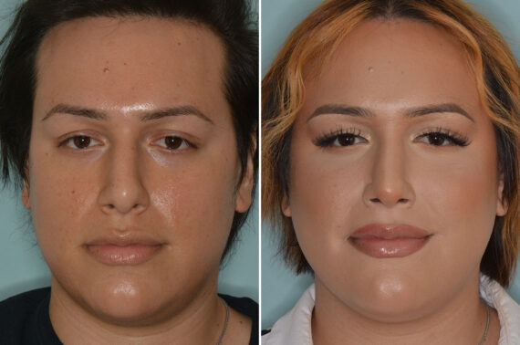 Rhinoplasty Before and After Photos in Miami, FL, Patient 7959