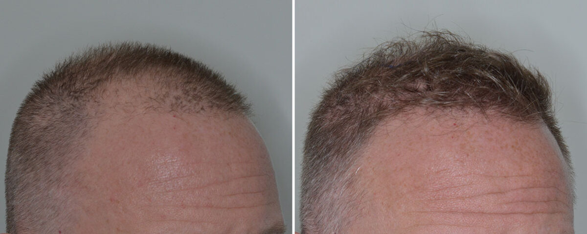 Hair Transplant Before and After Photos in Miami, FL, Patient 7973