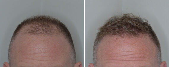 Hair Transplant Before and After Photos in Miami, FL, Patient 7973