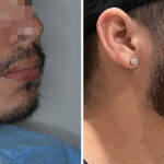 Beard Transplant Before and After Photos in Miami, FL, Patient 7994