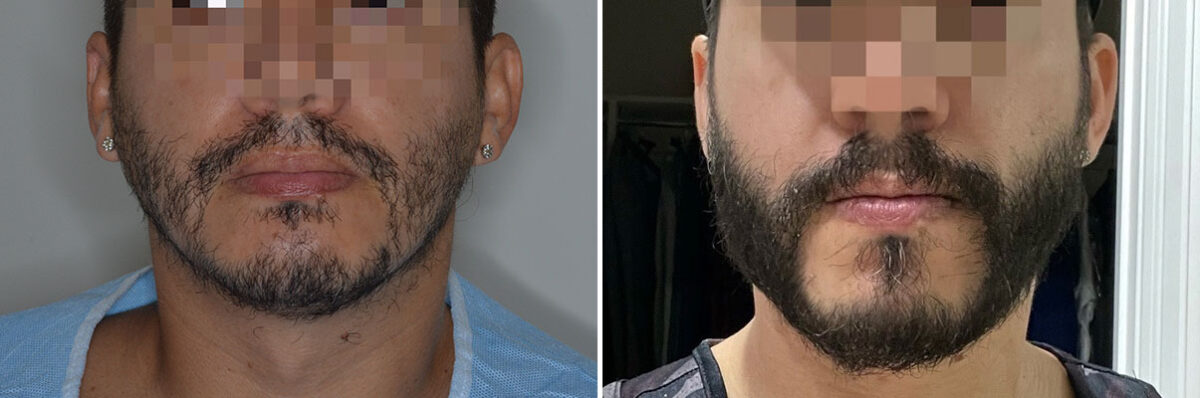 Beard Transplant Before and After Photos in Miami, FL, Patient 7994