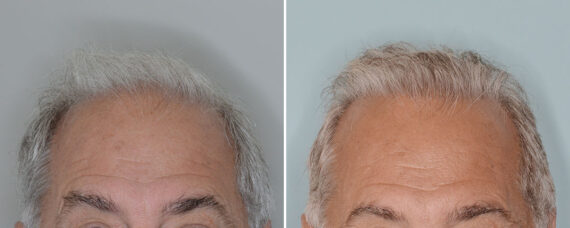 Hair Transplant Before and After Photos in Miami, FL, Patient 8004