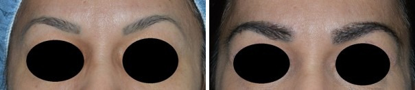 Eyebrow Transplant Before and After Photos in Miami, FL, Patient 1652