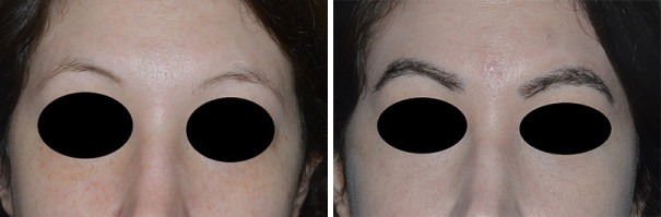 Eyebrow Transplant Before and After Photos in Miami, FL, Patient 2728