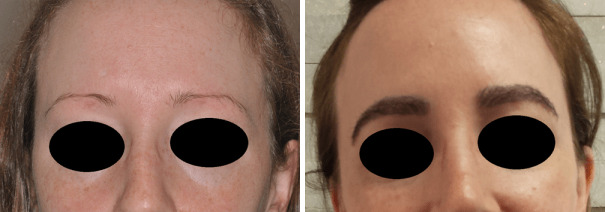 Eyebrow Transplant Before and After Photos in Miami, FL, Patient 2731