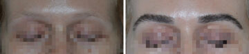 Eyebrow Transplant Before and After Photos in Miami, FL, Patient 8050