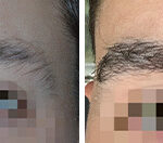 Eyebrow Transplant Before and After Photos in Miami, FL, Patient 8054