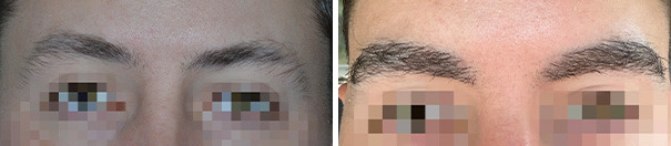 Eyebrow Transplant Before and After Photos in Miami, FL, Patient 8054