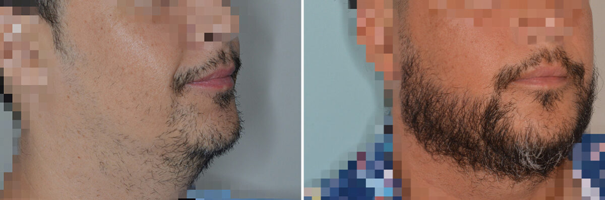 Beard Transplant Before and After Photos in Miami, FL, Patient 8058