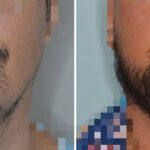 Beard Transplant Before and After Photos in Miami, FL, Patient 8058