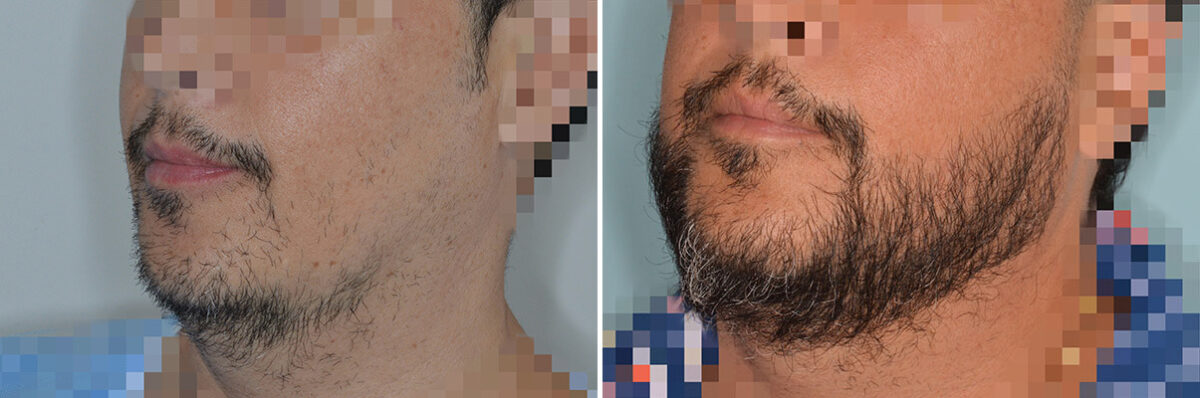 Beard Transplant Before and After Photos in Miami, FL, Patient 8058