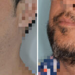 Beard Transplant Before and After Photos in Miami, FL, Patient 8058