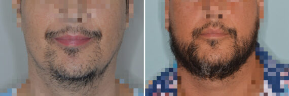Beard Transplant Before and After Photos in Miami, FL, Patient 8058