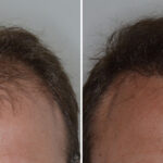 Hair Transplant Before and After Photos in Miami, FL, Patient 8068