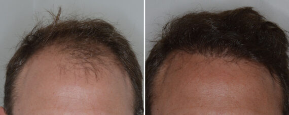 Hair Transplant Before and After Photos in Miami, FL, Patient 8068