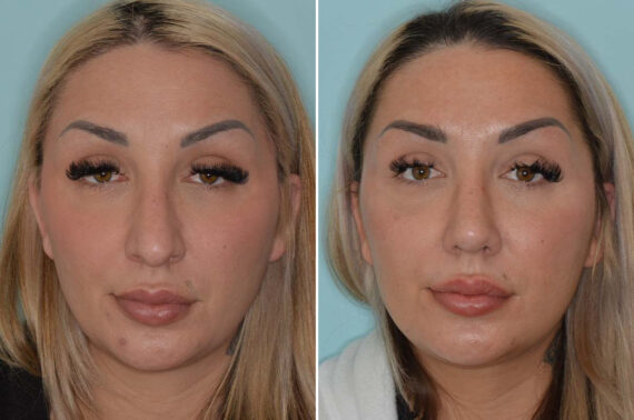 Rhinoplasty Before and After Photos in Miami, FL, Patient 8078