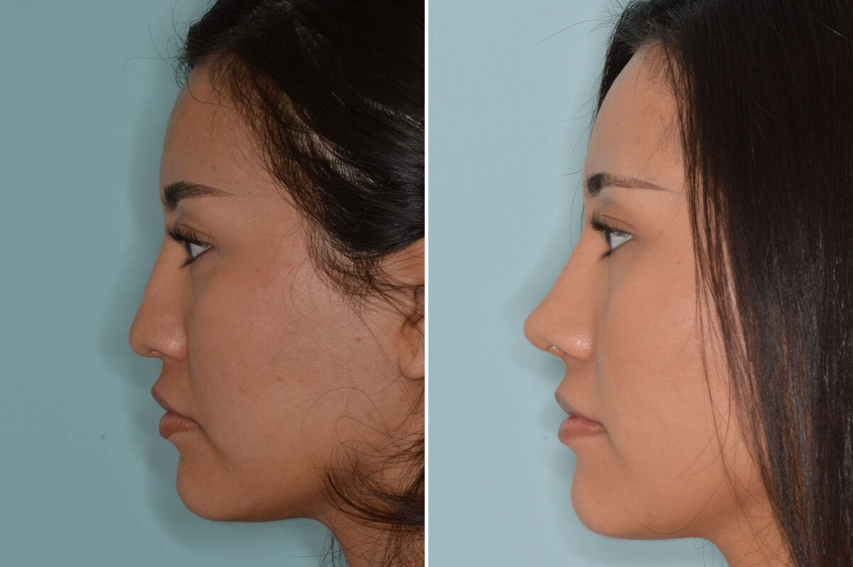 Ethnic Rhinoplasty Before and After Photos in Miami, FL, Patient 8088