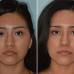 Ethnic Rhinoplasty Before and After Photos in Miami, FL, Patient 8088