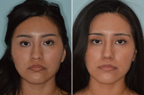 Ethnic Rhinoplasty Before and After Photos in Miami, FL, Patient 8088