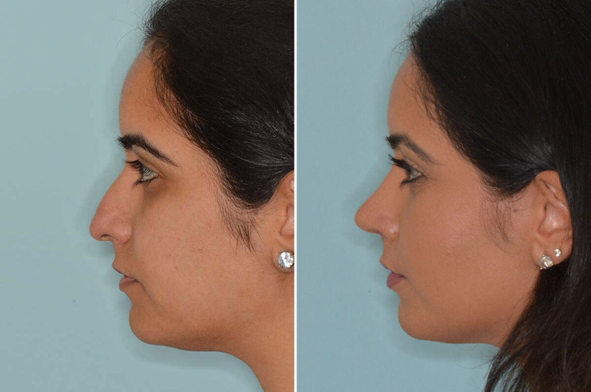 Ethnic Rhinoplasty Before and After Photos in Miami, FL, Patient 8098