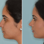 Ethnic Rhinoplasty Before and After Photos in Miami, FL, Patient 8098