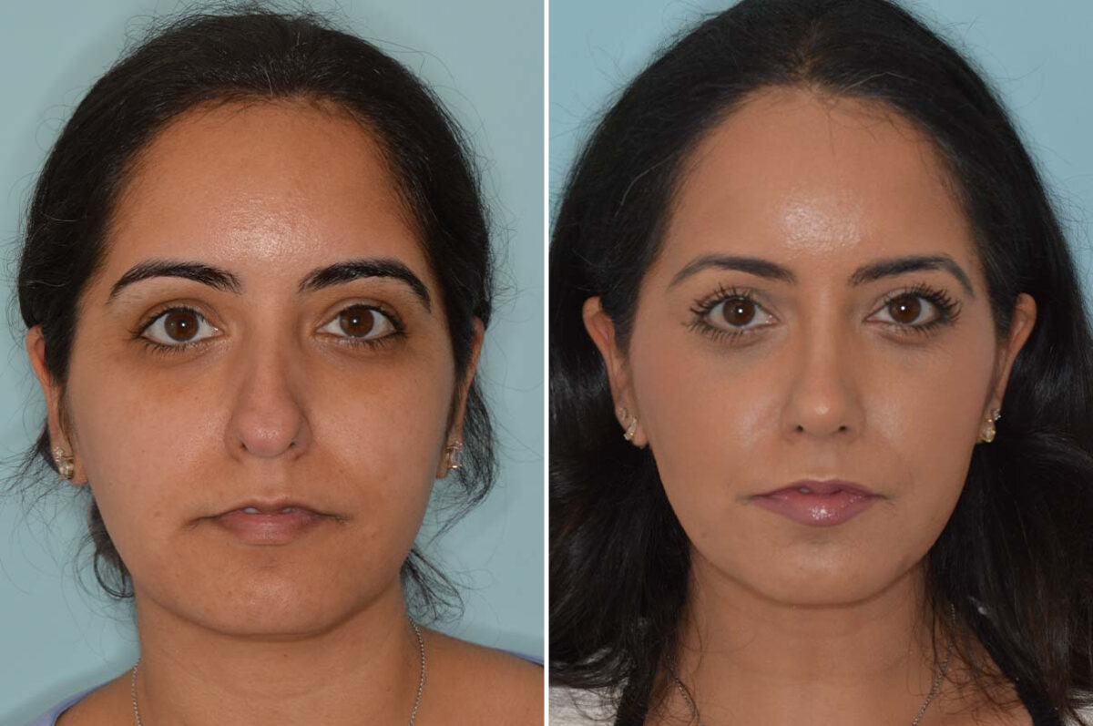 Ethnic Rhinoplasty Before and After Photos in Miami, FL, Patient 8098