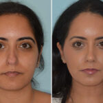 Ethnic Rhinoplasty Before and After Photos in Miami, FL, Patient 8098