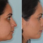 Ethnic Rhinoplasty Before and After Photos in Miami, FL, Patient 8098