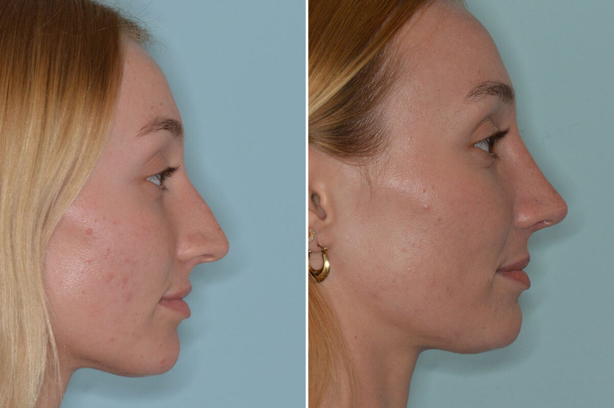 Rhinoplasty Before and After Photos in Miami, FL, Patient 8108